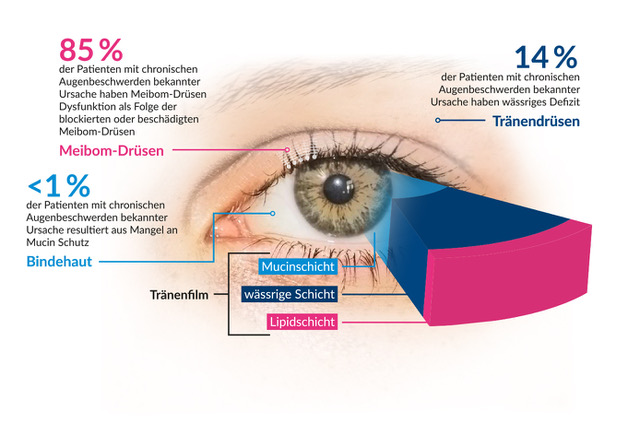 Die Grafik zeigt den Formen des trockenen Auges