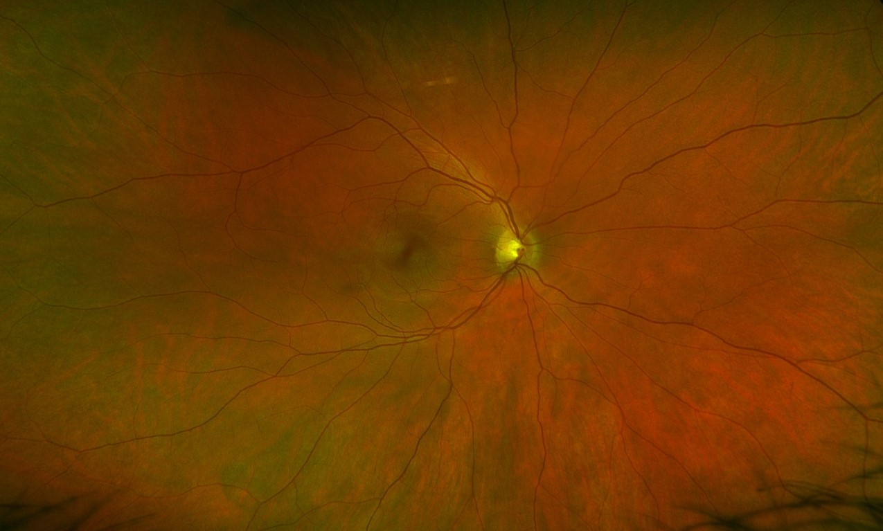gesundes Auge ohne Diabetes mellitus