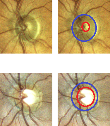 Die vier Bilder zeigen die Aufnahme eines an Glaukom / Grüner Star erkrankten Auges