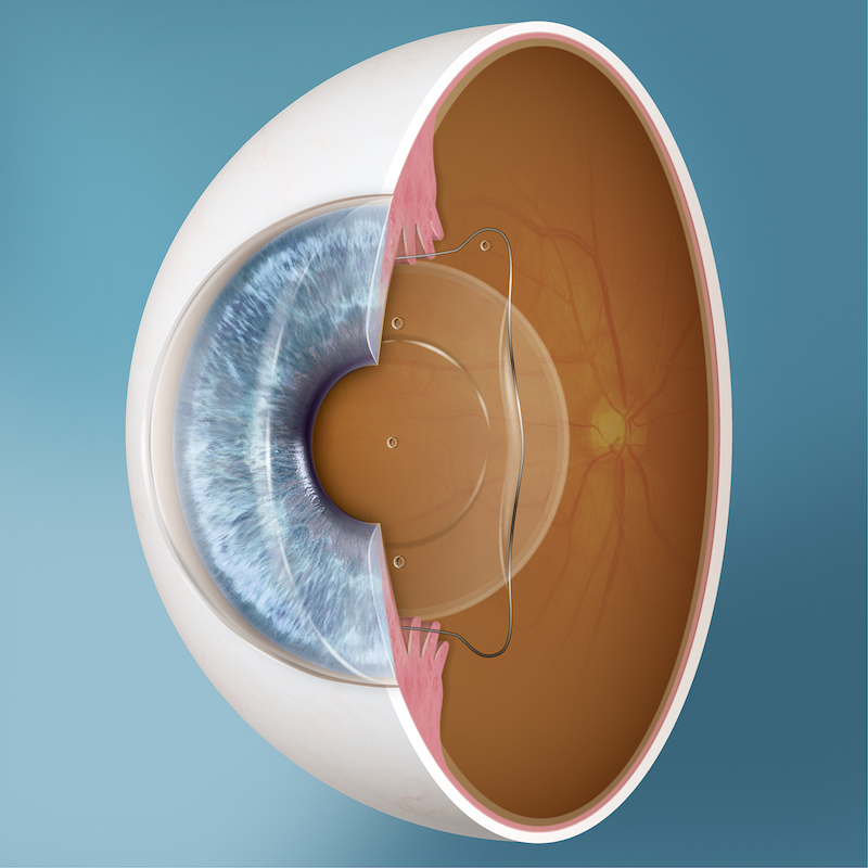 Implantierbare Kontaktlinsen für Brillenfreiheit ohne Augenlasern 
