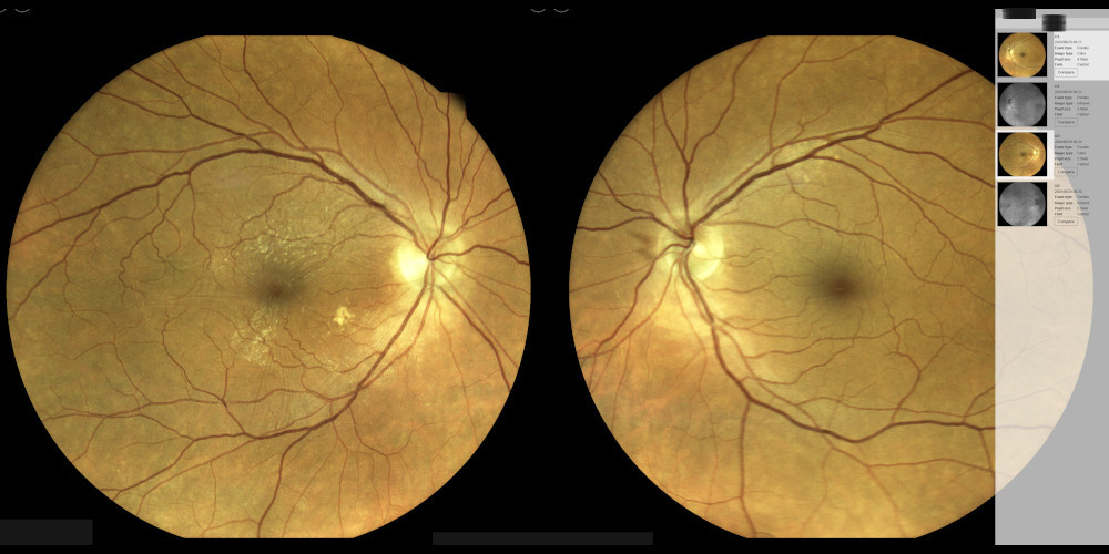 Epiretinale Gliose im Auge